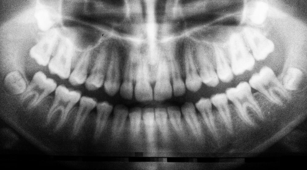 Wisdom Teeth Contain Unique Stem Cell That Can Form Cartilage, Neurons, and Heart Tissue
