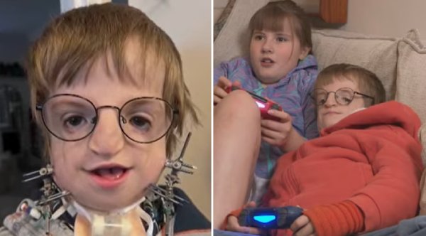 Surgeons Rebuild Boyand#039;s Jaw Using His Own Rib Bone, Allowing Him To Breathe And Eat On His Own